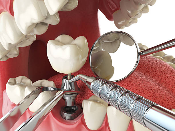 Best Emergency Wisdom Teeth Removal in Prunedale, CA